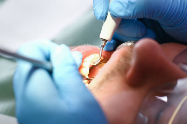 Best Emergency Dental Care for Broken or Chipped Teeth in Maryville, MO