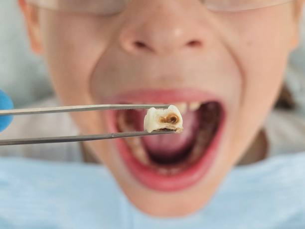 Best Emergency Treatment for Dental Infections or Abscesses in Maryville, MO